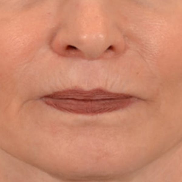 Lip Lift Before & After Gallery - Patient 218091 - Image 2