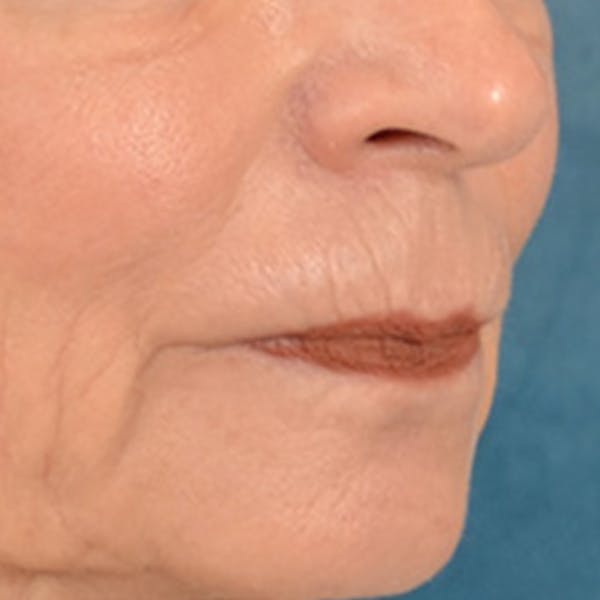 Lip Lift Before & After Gallery - Patient 218091 - Image 3
