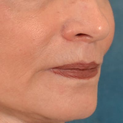 Lip Lift Before & After Gallery - Patient 218091 - Image 4