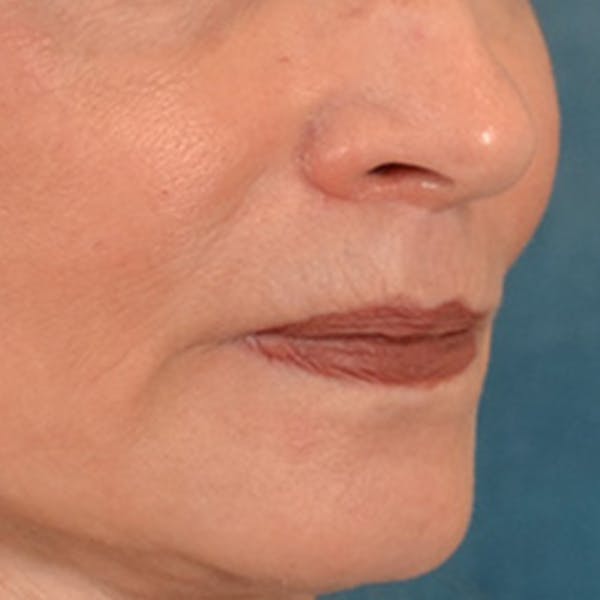 Lip Lift Before & After Gallery - Patient 218091 - Image 4