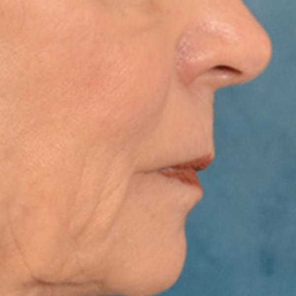 Lip Lift Before & After Gallery - Patient 218091 - Image 5