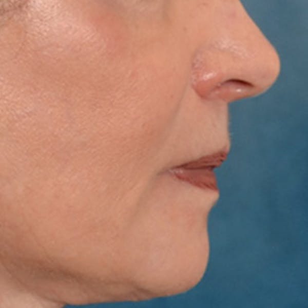 Lip Lift Before & After Gallery - Patient 218091 - Image 6