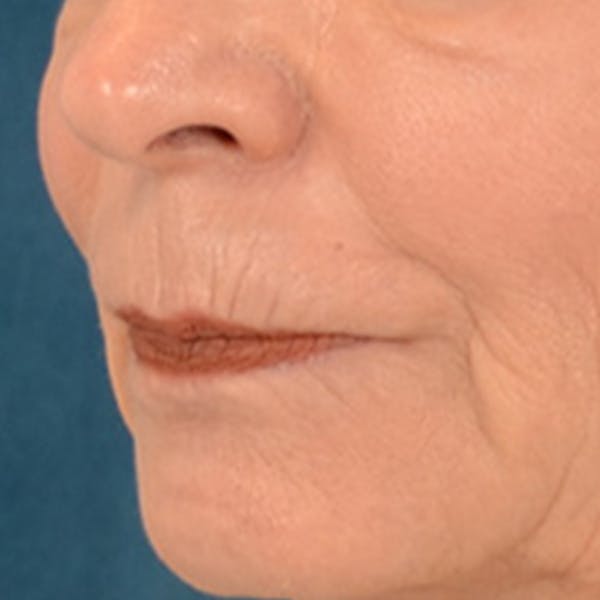 Lip Lift Before & After Gallery - Patient 218091 - Image 7