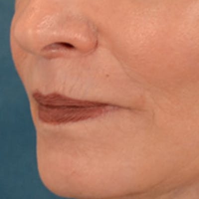 Lip Lift Before & After Gallery - Patient 218091 - Image 8