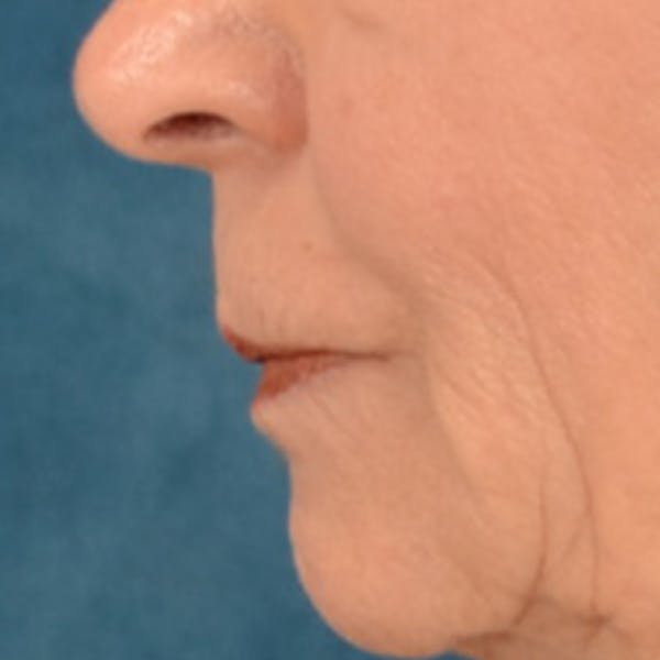 Lip Lift Before & After Gallery - Patient 218091 - Image 9