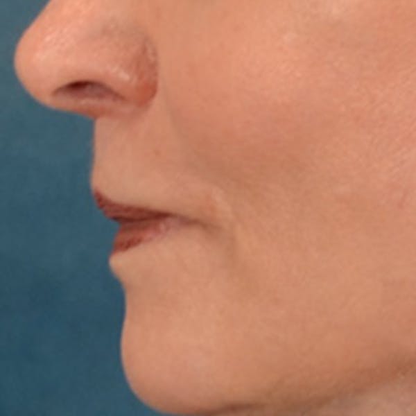 Lip Lift Before & After Gallery - Patient 218091 - Image 10