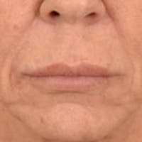 Lip Lift Before & After Gallery - Patient 108832 - Image 1