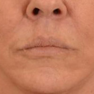 Lip Lift Before & After Gallery - Patient 108832 - Image 2