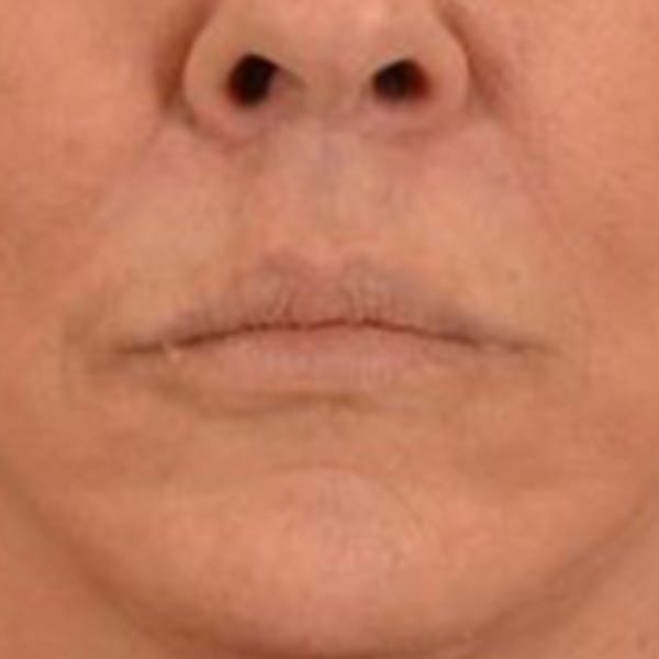 Lip Lift Before & After Gallery - Patient 108832 - Image 2