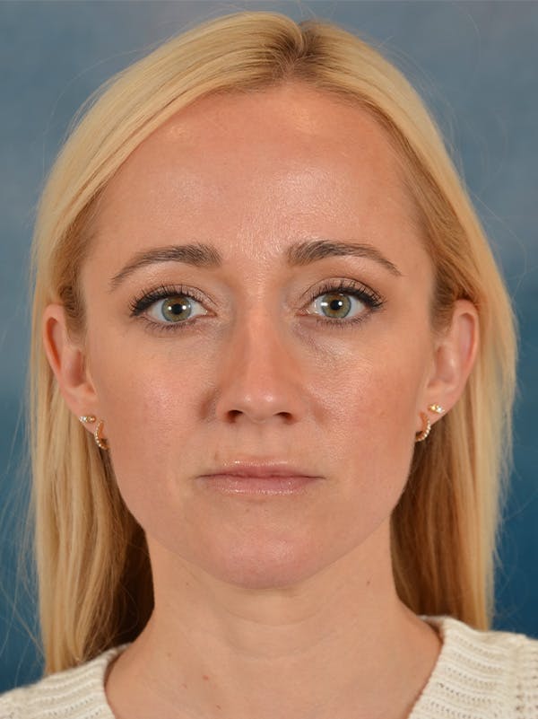 Rhinoplasty Before & After Gallery - Patient 694158 - Image 5