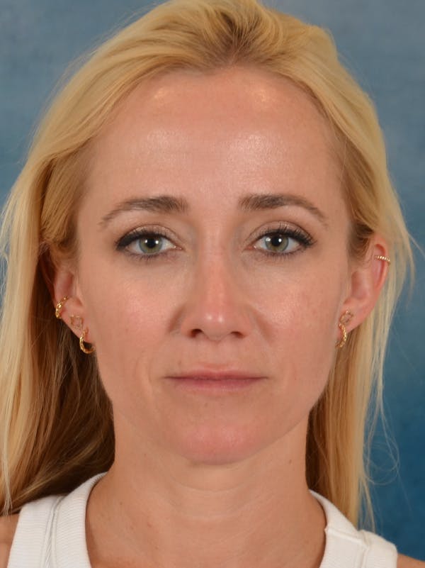 Rhinoplasty Before & After Gallery - Patient 694158 - Image 6
