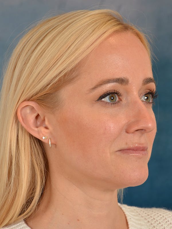 Rhinoplasty Before & After Gallery - Patient 694158 - Image 7