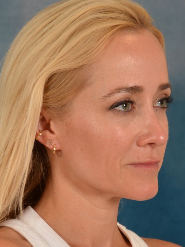Rhinoplasty Before & After Gallery - Patient 694158 - Image 8
