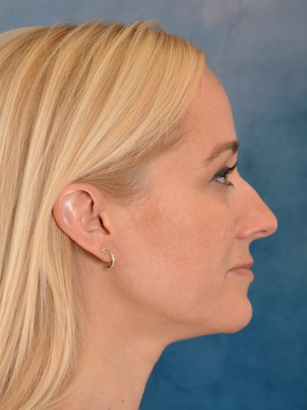 Rhinoplasty Before & After Gallery - Patient 694158 - Image 9
