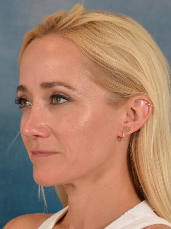 Rhinoplasty Before & After Gallery - Patient 694158 - Image 4
