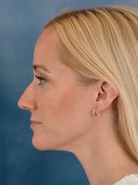 Rhinoplasty Before & After Gallery - Patient 544468 - Image 1