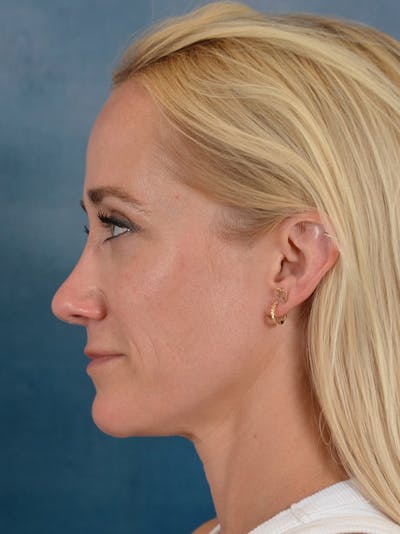 Rhinoplasty Before & After Gallery - Patient 694158 - Image 2