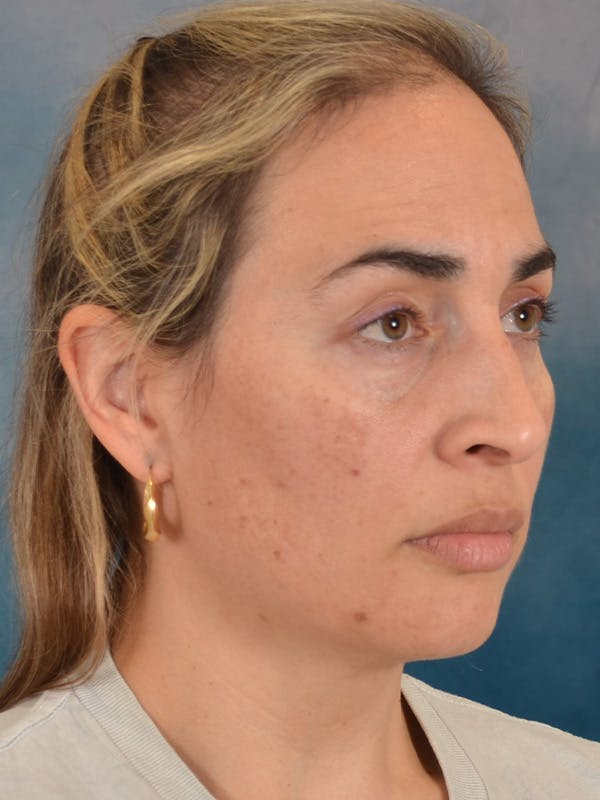 Deep Neck Lift Before & After Gallery - Patient 279405 - Image 7