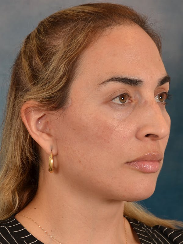 Deep Neck Lift Before & After Gallery - Patient 279405 - Image 8