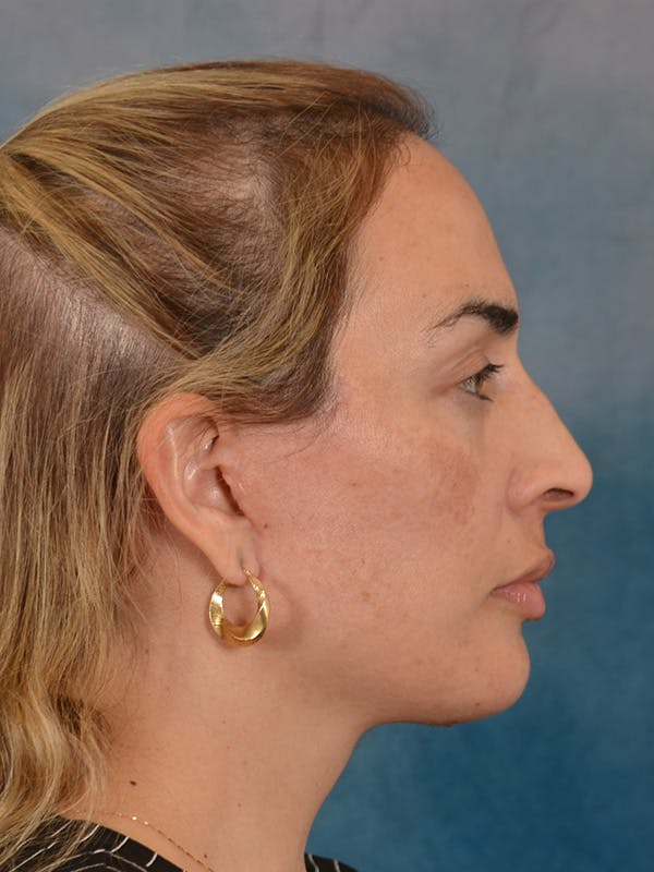 Deep Neck Lift Before & After Gallery - Patient 279405 - Image 10