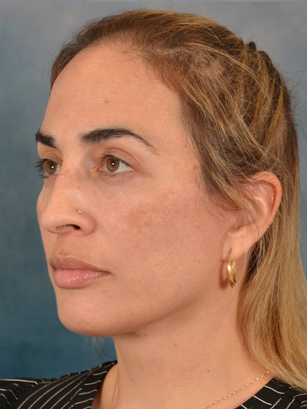 Deep Neck Lift Before & After Gallery - Patient 279405 - Image 4