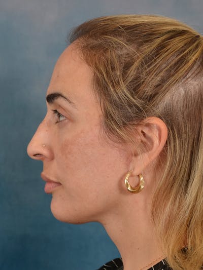 Deep Neck Lift Before & After Gallery - Patient 279405 - Image 6