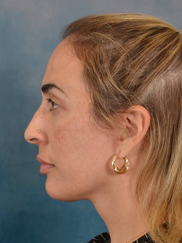 Deep Neck Lift Before & After Gallery - Patient 279405 - Image 6