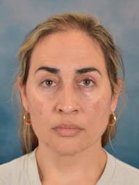 Deep Neck Lift Before & After Gallery - Patient 279405 - Image 1