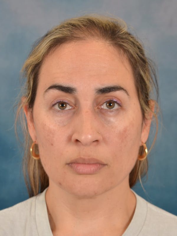 Deep Neck Lift Before & After Gallery - Patient 279405 - Image 1