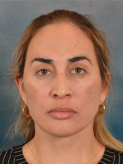 Deep Neck Lift Before & After Gallery - Patient 279405 - Image 2