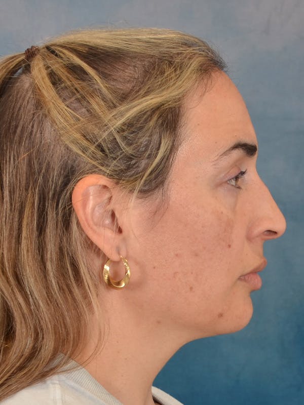 Deep Neck Lift Before & After Gallery - Patient 279405 - Image 9
