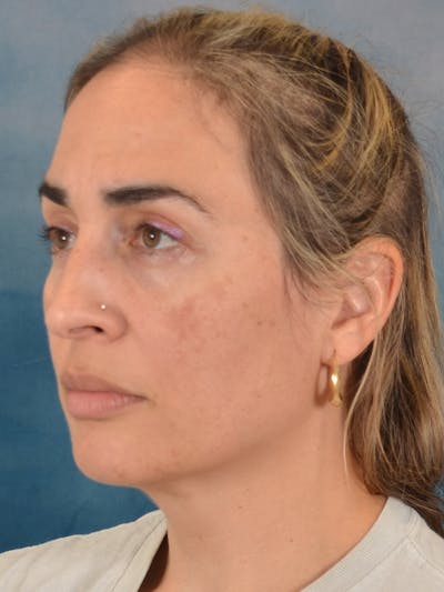 Deep Plane Facelift Before & After Gallery - Patient 105420 - Image 1