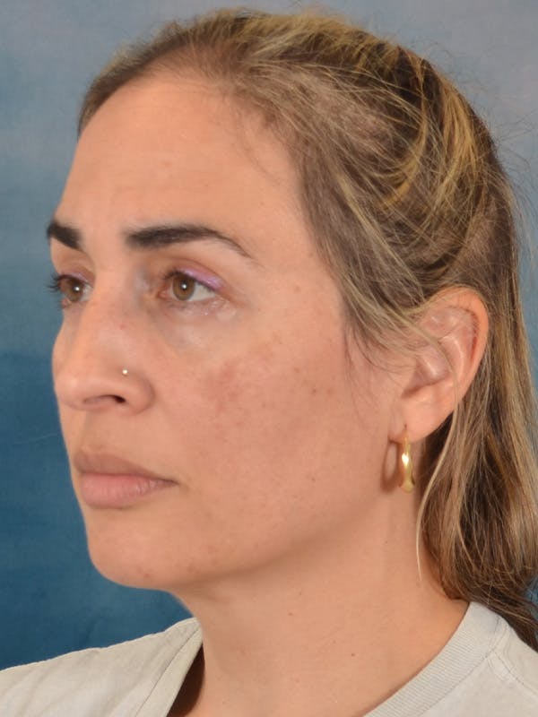 Deep Neck Lift Before & After Gallery - Patient 279405 - Image 3