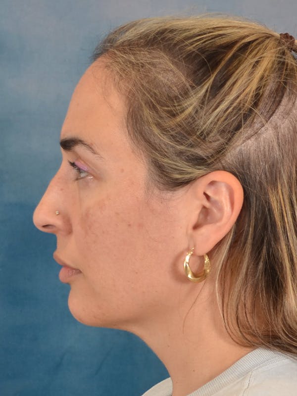 Deep Neck Lift Before & After Gallery - Patient 279405 - Image 5
