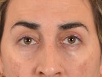 Eyelid Lift Before & After Gallery - Patient 255868 - Image 1