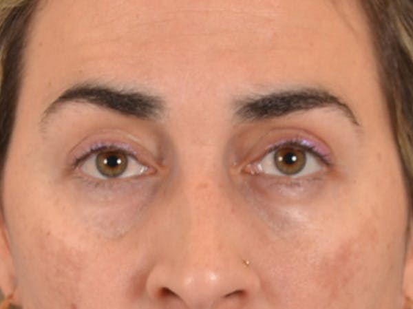 Eyelid Lift Before & After Gallery - Patient 255868 - Image 1