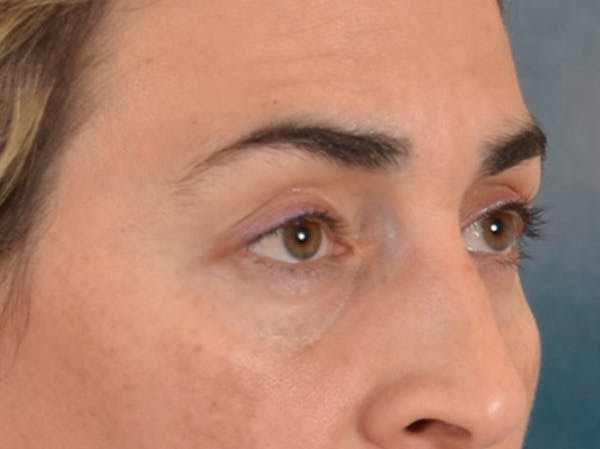 Eyelid Lift Before & After Gallery - Patient 255868 - Image 3