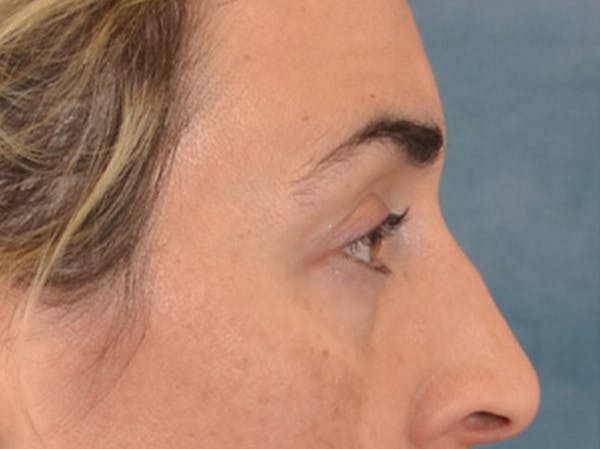 Eyelid Lift Before & After Gallery - Patient 255868 - Image 5