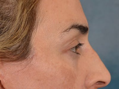 Eyelid Lift Before & After Gallery - Patient 255868 - Image 6