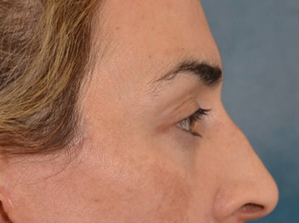 Eyelid Lift Before & After Gallery - Patient 255868 - Image 6