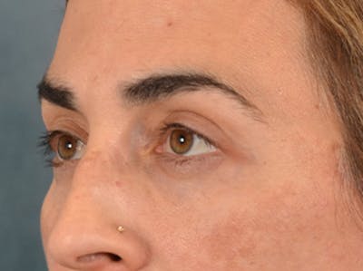 Eyelid Lift Before & After Gallery - Patient 255868 - Image 8