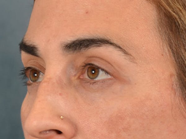 Eyelid Lift Before & After Gallery - Patient 255868 - Image 8