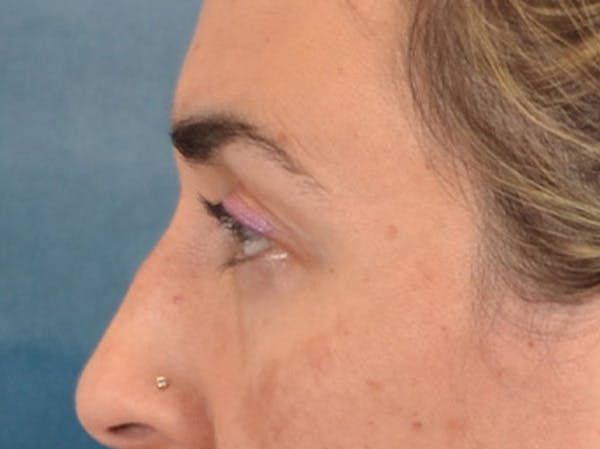 Eyelid Lift Before & After Gallery - Patient 255868 - Image 9