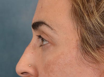 Eyelid Lift Before & After Gallery - Patient 255868 - Image 10