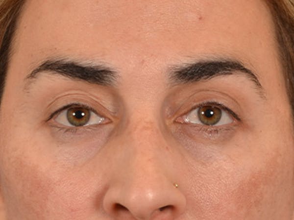 Eyelid Lift Before & After Gallery - Patient 255868 - Image 2