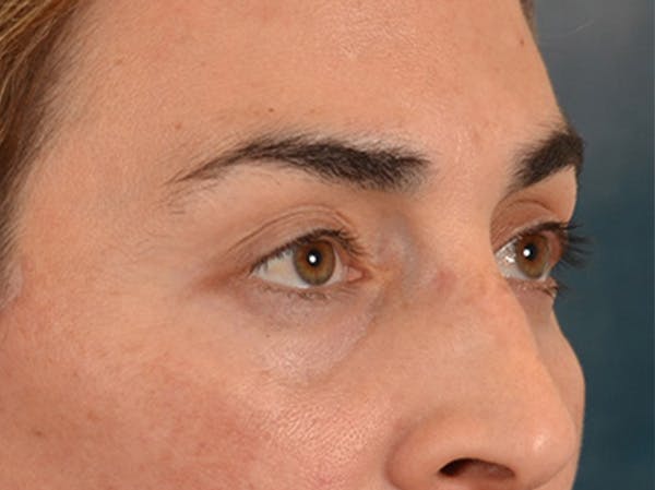 Eyelid Lift Before & After Gallery - Patient 255868 - Image 4