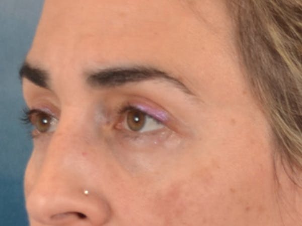 Eyelid Lift Before & After Gallery - Patient 255868 - Image 7