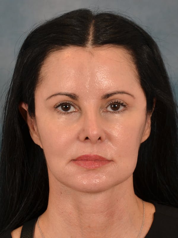 Laser Skin Resurfacing Before & After Gallery - Patient 141925 - Image 2