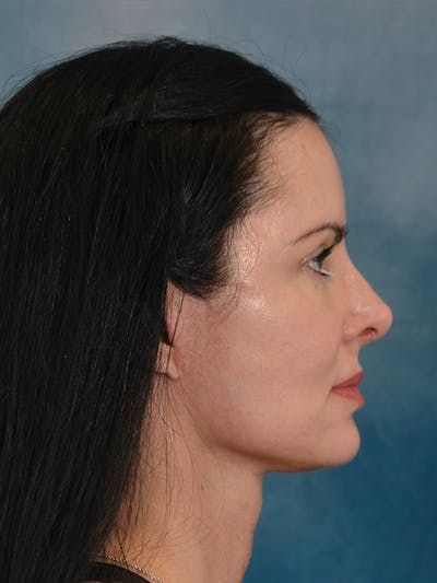 Laser Skin Resurfacing Before & After Gallery - Patient 141925 - Image 10