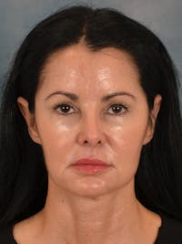 Laser Skin Resurfacing Before & After Gallery - Patient 141925 - Image 1
